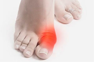 Who has a bump» on the&foot? Doctor —about valgus deformity of the first toe